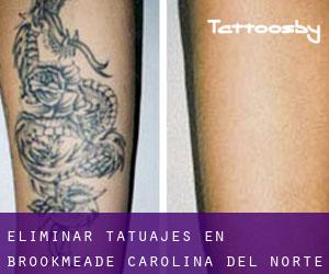 Eliminar tatuajes en Brookmeade (Carolina del Norte)
