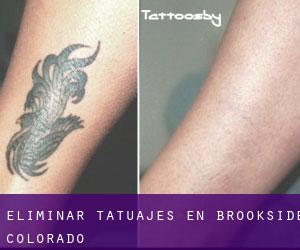 Eliminar tatuajes en Brookside (Colorado)