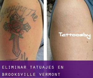 Eliminar tatuajes en Brooksville (Vermont)