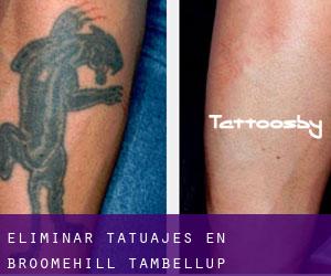 Eliminar tatuajes en Broomehill-Tambellup