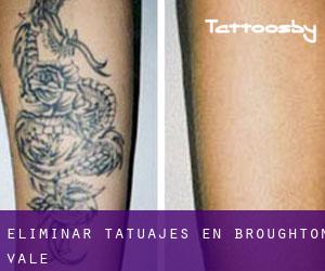 Eliminar tatuajes en Broughton Vale