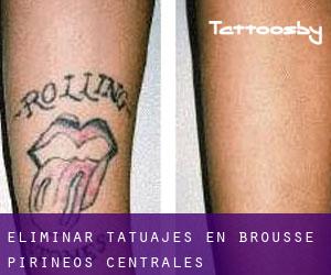 Eliminar tatuajes en Brousse (Pirineos Centrales)
