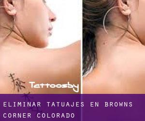 Eliminar tatuajes en Browns Corner (Colorado)