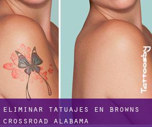 Eliminar tatuajes en Browns Crossroad (Alabama)