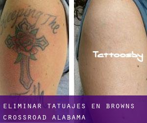 Eliminar tatuajes en Browns Crossroad (Alabama)