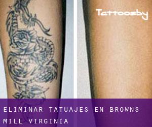 Eliminar tatuajes en Browns Mill (Virginia)