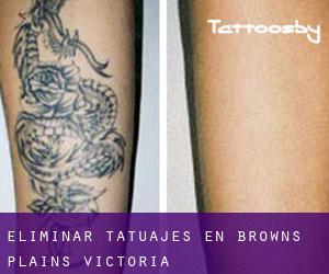 Eliminar tatuajes en Browns Plains (Victoria)
