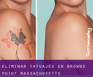 Eliminar tatuajes en Browns Point (Massachusetts)