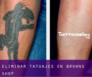 Eliminar tatuajes en Browns Shop