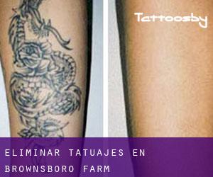 Eliminar tatuajes en Brownsboro Farm