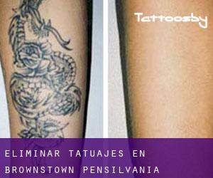 Eliminar tatuajes en Brownstown (Pensilvania)