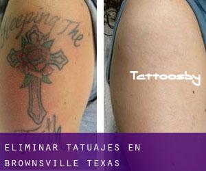 Eliminar tatuajes en Brownsville (Texas)