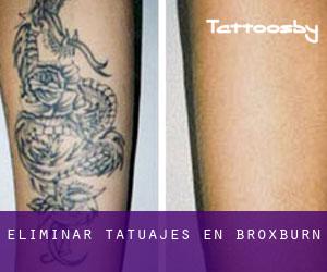 Eliminar tatuajes en Broxburn