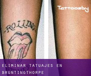 Eliminar tatuajes en Bruntingthorpe