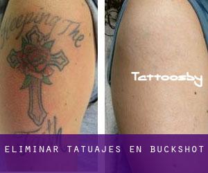 Eliminar tatuajes en Buckshot