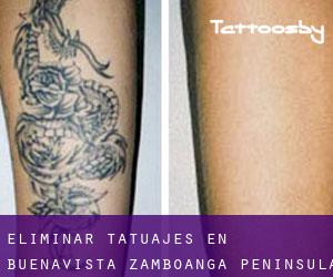 Eliminar tatuajes en Buenavista (Zamboanga Peninsula)