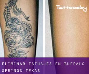 Eliminar tatuajes en Buffalo Springs (Texas)