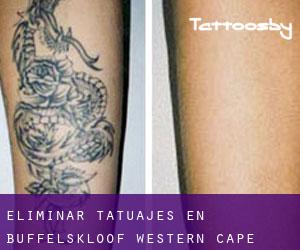 Eliminar tatuajes en Buffelskloof (Western Cape)
