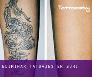 Eliminar tatuajes en Buhi