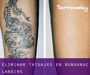 Eliminar tatuajes en Bunganuc Landing