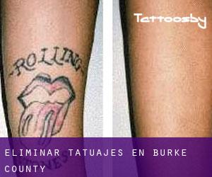 Eliminar tatuajes en Burke County