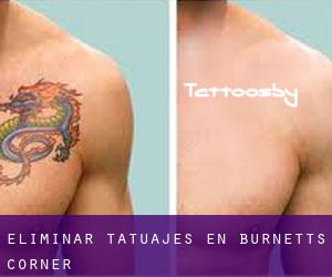 Eliminar tatuajes en Burnetts Corner