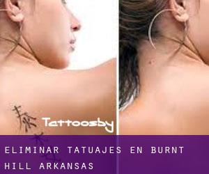 Eliminar tatuajes en Burnt Hill (Arkansas)