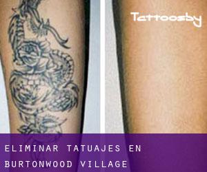 Eliminar tatuajes en Burtonwood Village