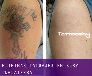 Eliminar tatuajes en Bury (Inglaterra)