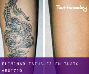 Eliminar tatuajes en Busto Arsizio