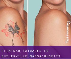 Eliminar tatuajes en Butlerville (Massachusetts)