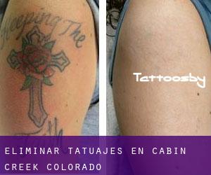 Eliminar tatuajes en Cabin Creek (Colorado)