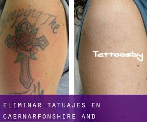 Eliminar tatuajes en Caernarfonshire and Merionethshire