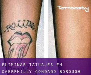 Eliminar tatuajes en Caerphilly (Condado Borough)