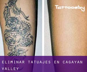 Eliminar tatuajes en Cagayan Valley