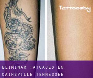 Eliminar tatuajes en Cainsville (Tennessee)