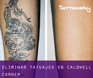 Eliminar tatuajes en Caldwell Corner