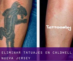 Eliminar tatuajes en Caldwell (Nueva Jersey)
