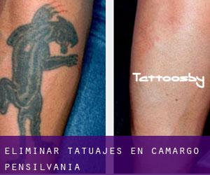 Eliminar tatuajes en Camargo (Pensilvania)