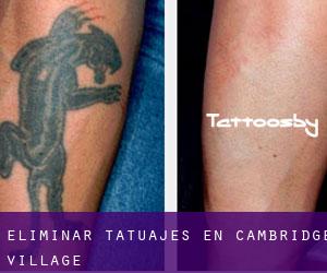Eliminar tatuajes en Cambridge Village