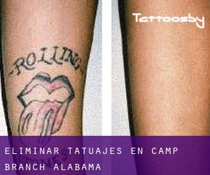 Eliminar tatuajes en Camp Branch (Alabama)