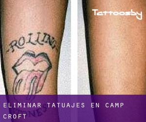 Eliminar tatuajes en Camp Croft