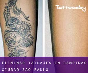 Eliminar tatuajes en Campinas (Ciudad) (São Paulo)