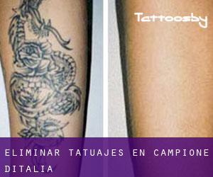 Eliminar tatuajes en Campione d'Italia