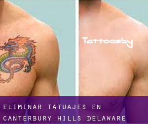 Eliminar tatuajes en Canterbury Hills (Delaware)