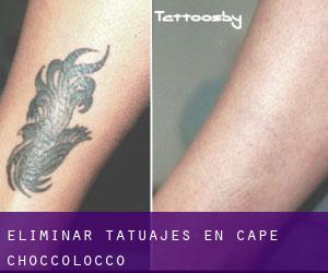 Eliminar tatuajes en Cape Choccolocco