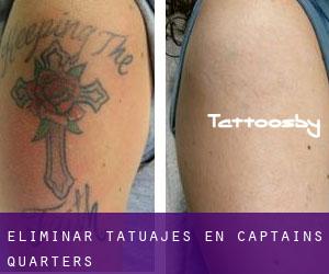 Eliminar tatuajes en Captains Quarters