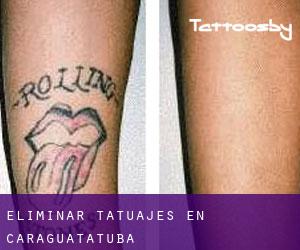 Eliminar tatuajes en Caraguatatuba