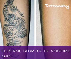 Eliminar tatuajes en Cardenal Caro