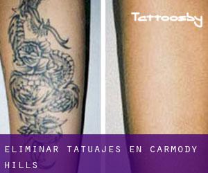 Eliminar tatuajes en Carmody Hills
